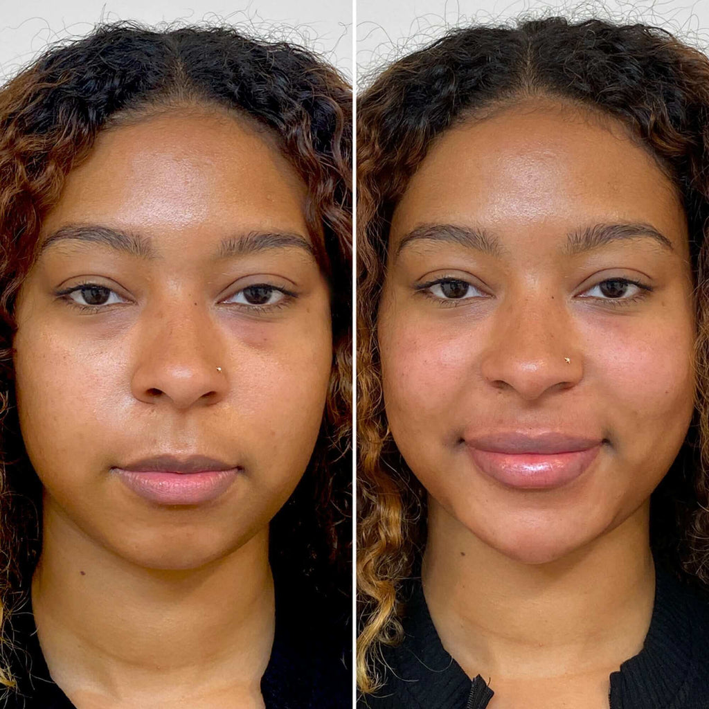 FaceFix: Liquid Face Lift – Beauty Fix MedSpa