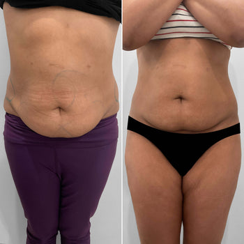 COOLSCULPTING