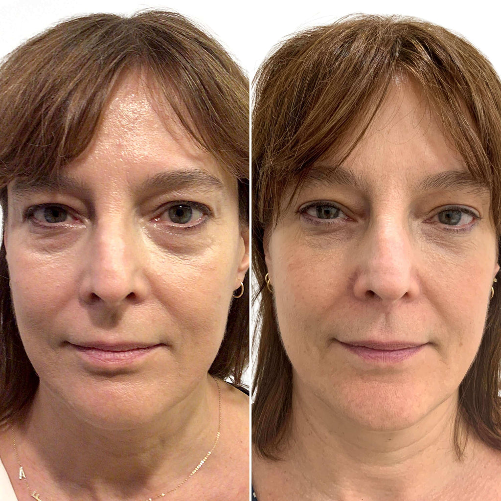 FaceFix: Liquid Face Lift – Beauty Fix MedSpa