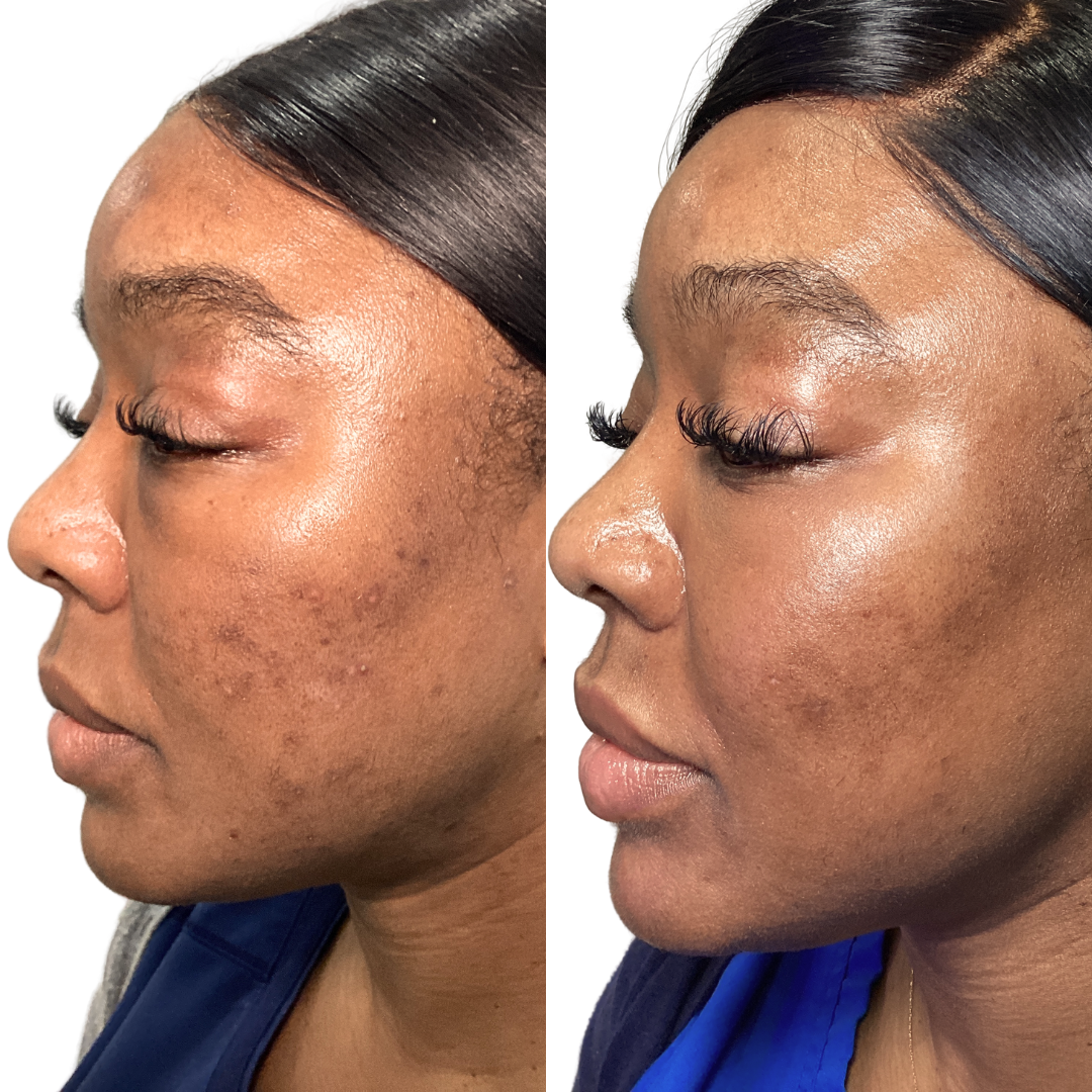 SkinFix: DSE Peel + Microneedling – Beauty Fix MedSpa