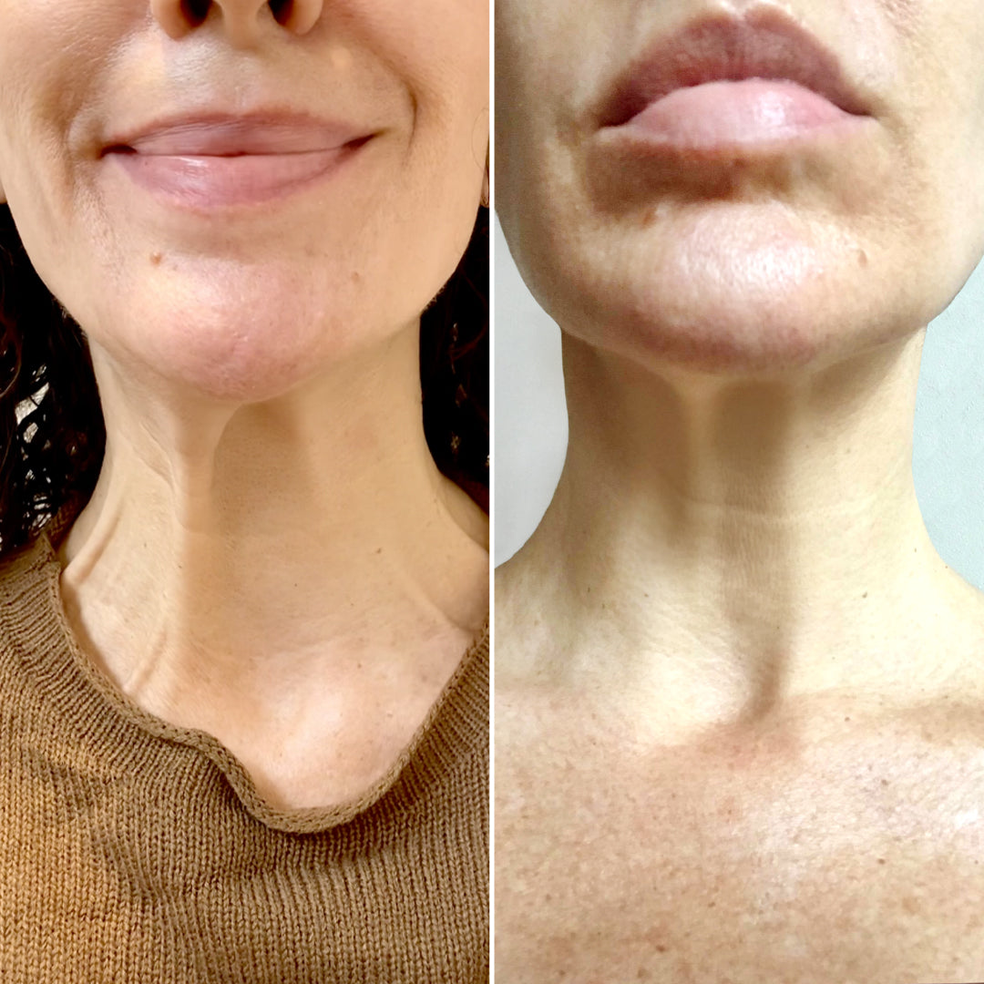 NeckFix: Nefertiti Lift – Beauty Fix MedSpa