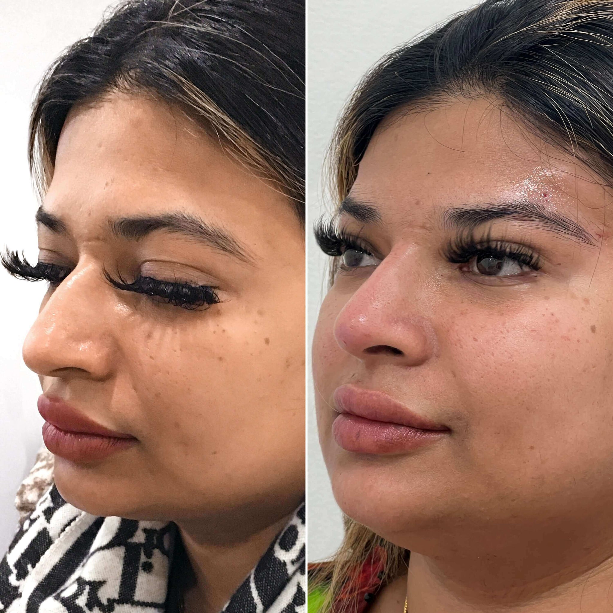 NoseFix: Slimming – Beauty Fix MedSpa