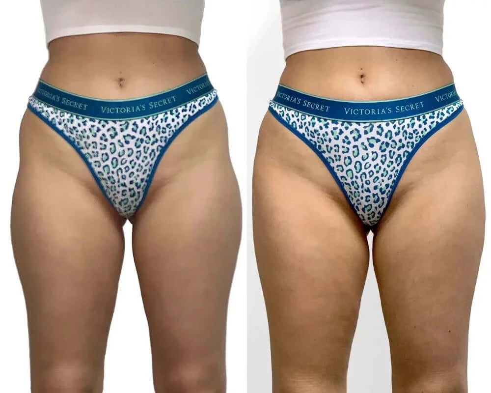 Pink Door - Buttlift primarily for hip dip correction One session with  @prolific_pink Signature Pink Door Buttlifts includes hip dip correction..  This may seem minimal.. and not red.. and not extreme.. but